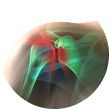 rotatorcuff